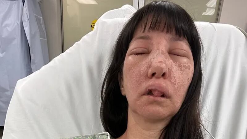 Jessica Rogue fue hospitalizada después de ser picada por múltiples arañas reclusas pardas.